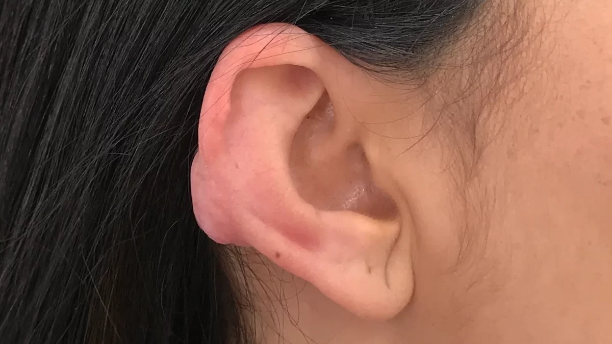 Tratamento de queloide em orelha após traumatismo