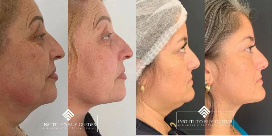 Antes e Depois da Lipo de Papada: O Que Esperar dos Resultados?