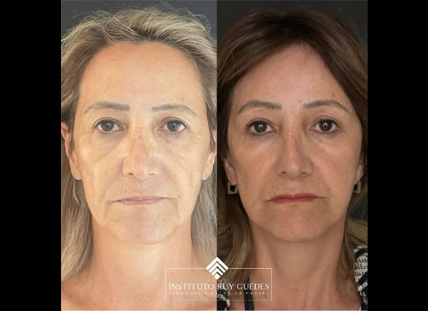 Frontoplastia em Porto Alegre