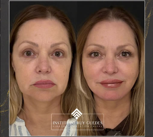 Smart Lifting: a evolução do rejuvenescimento facial com resultados naturais e sem grandes cicatrizes